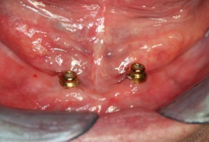 Implante CASO1